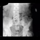 Spina bifida of lumbar vertebra: X-ray - Plain radiograph